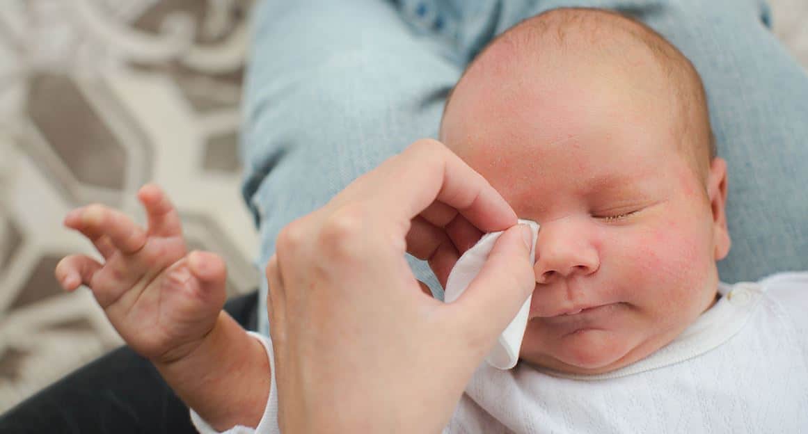 Comment Soigner Efficacement La Conjonctivite Chez Le Bébé