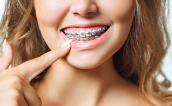 Orthodontie Appareil Dentaire