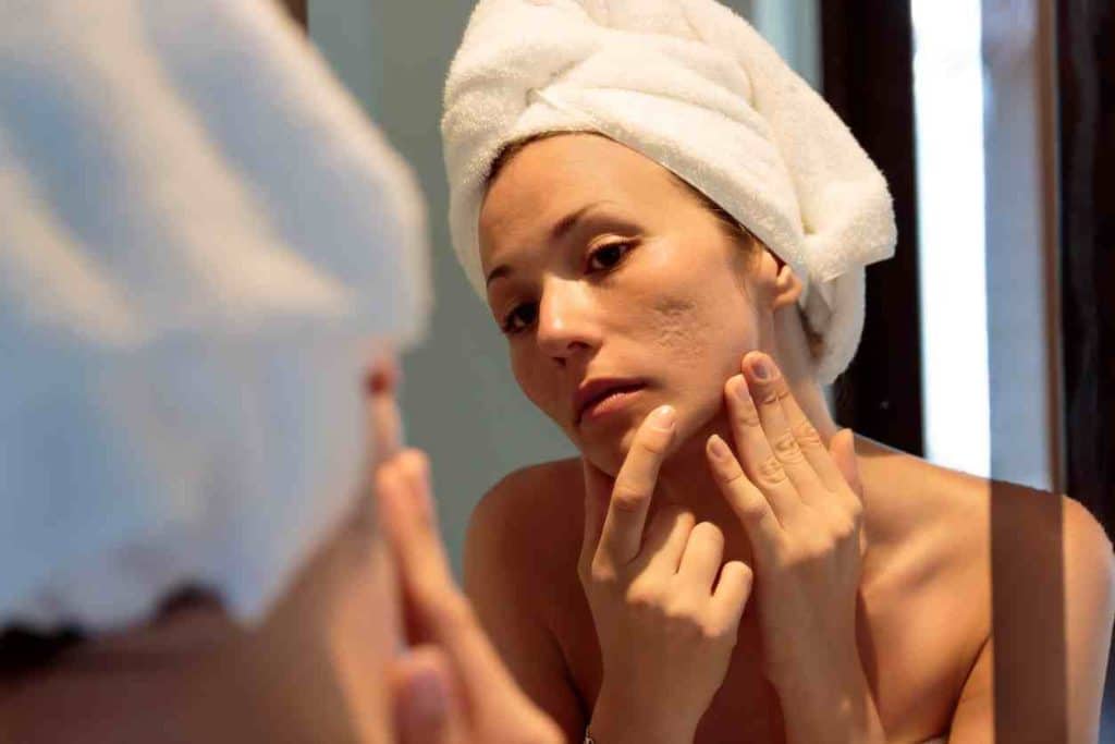Cicatrices Acne